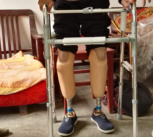 假肢对截肢患者的康复有哪些帮助？