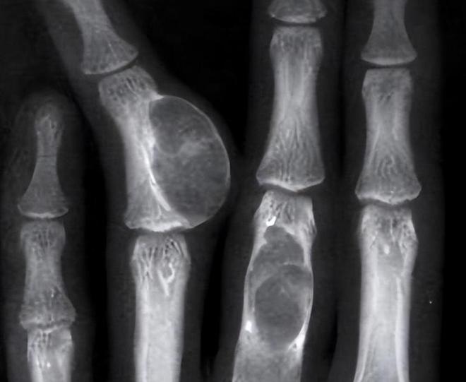 2012年河北女孩7年花200万抗癌亲友劝放弃怒道：我凭啥该死(图7)