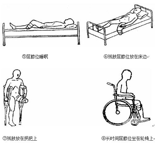 术后假肢装配的准备(图2)