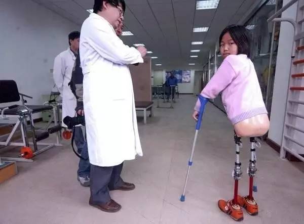假肢不是“假腿”它是重新走路的伙伴